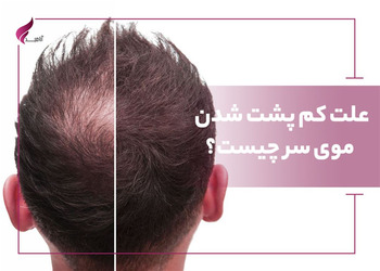 علت کم پشت شدن موی سر چیست؟