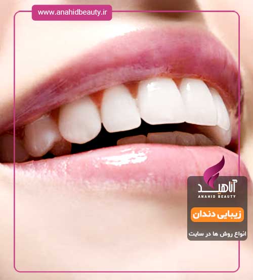 انواع روش های زیبایی دندان